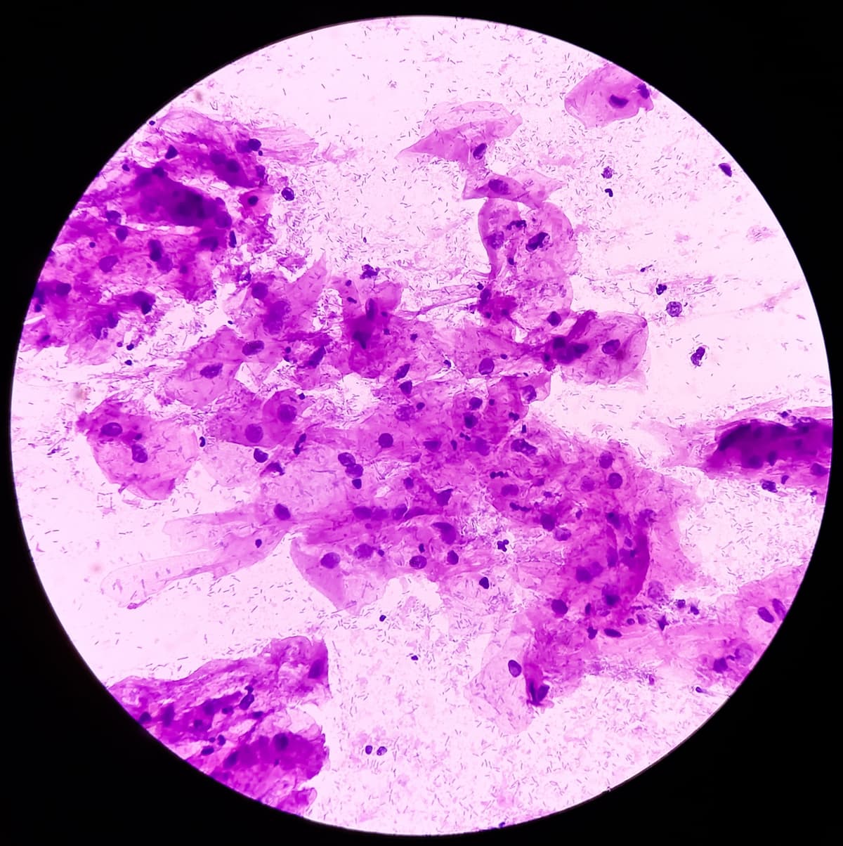 Cervical Dysplasia: Is It Cancer?