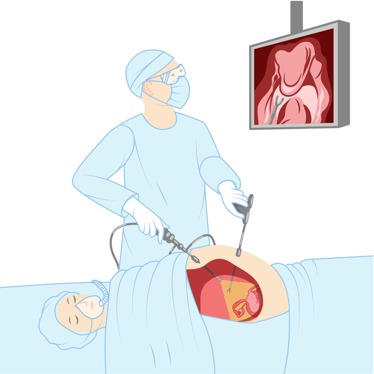 Laparoscopy for Endometriosis: What to Expect